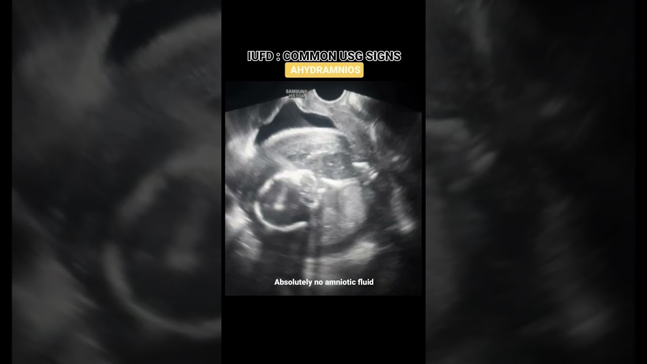 IUFD: INTRAUTERINE FETAL DEMISE. fetal death aftr 20 weeks #ultrasound #radiology #fetaldevelopment