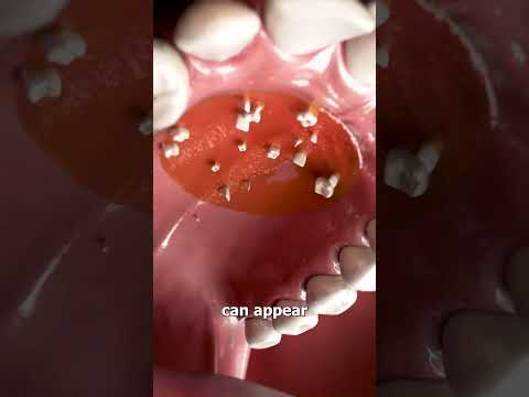 Hyperdontia: Extra Teeth in the Roof of Your Mouth? Learn About This Condition ! | Cosmodent India