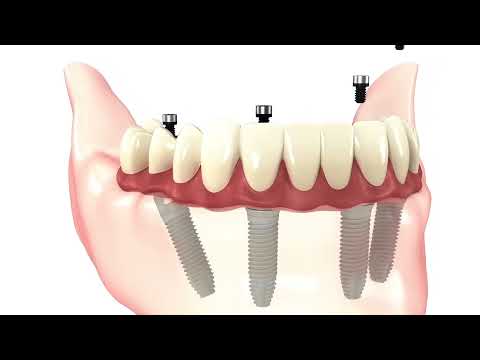 Dental Implants — Surgical Procedure