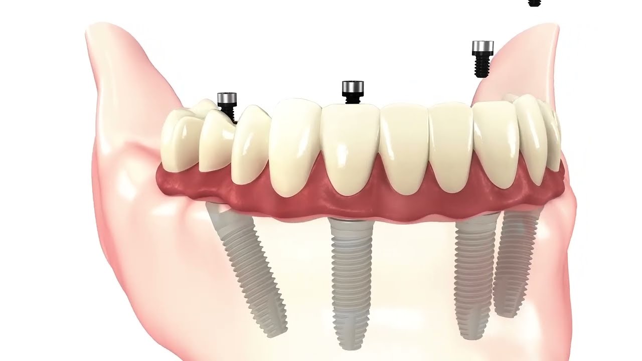 Dental Implants — Surgical Procedure