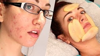 ✔ HOW TO: FADE ACNE SCARS WITH... POTATO?! Natural Mild Scarring Treatment!