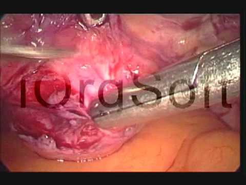 Laparoscopic Uterosacral Colpopexy, Ali Ghomi MD