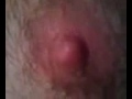 Nipple