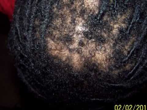 retwisting interlocking tightening dreads locs roots dangers traction alopecia