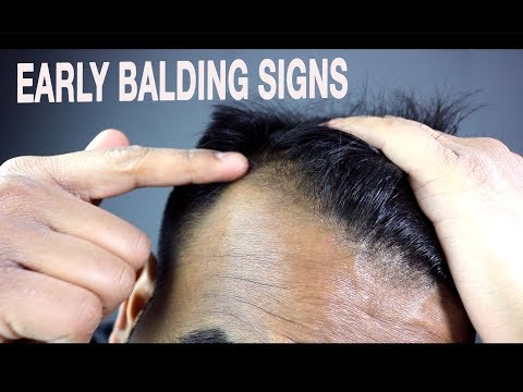 How To Know if You're Going Bald | Signs of Male Pattern Baldness