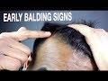 How To Know if You're Going Bald | Signs of Male Pattern Baldness