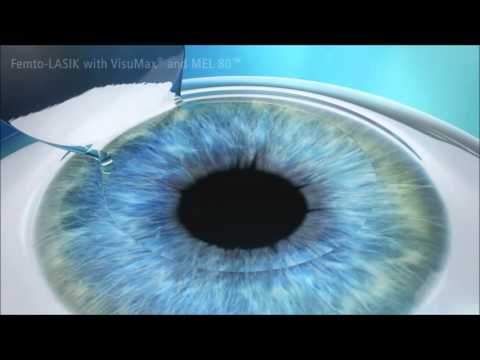 Femto LASIK
