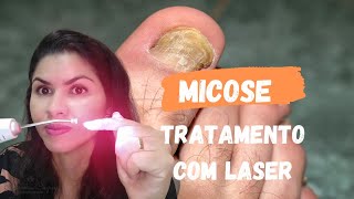 MICOSE NAS UNHAS DOS PÉS, TEM TRATAMENTO COM LASER!