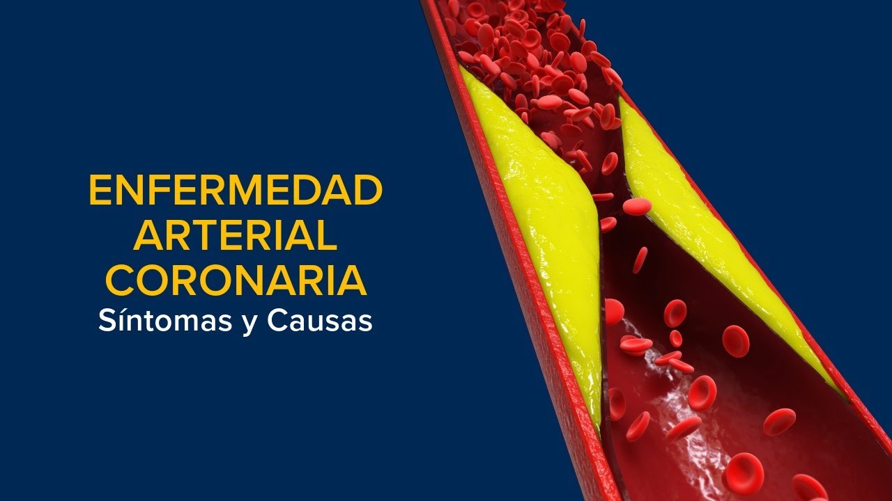 Thumbnail preview of Enfermedad Arterial Coronaria (EAC) - Síntomas y causas