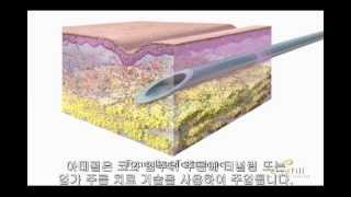 [광주벨라성형외과]영구필러아테필시술 동영상