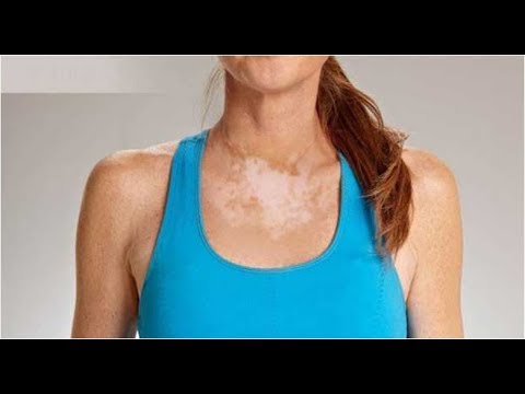 Le primavere di giardino di lentiggine sono messe Siccome è corretto per usare la crema di decolorazione