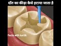 How To Remove Tooth Worm ‍ By Animation Shorts Shortvideo
