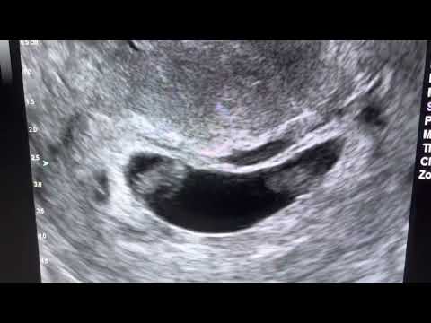 Follow Up of Split Embryo at 7 & 1/7 weeks gestation!