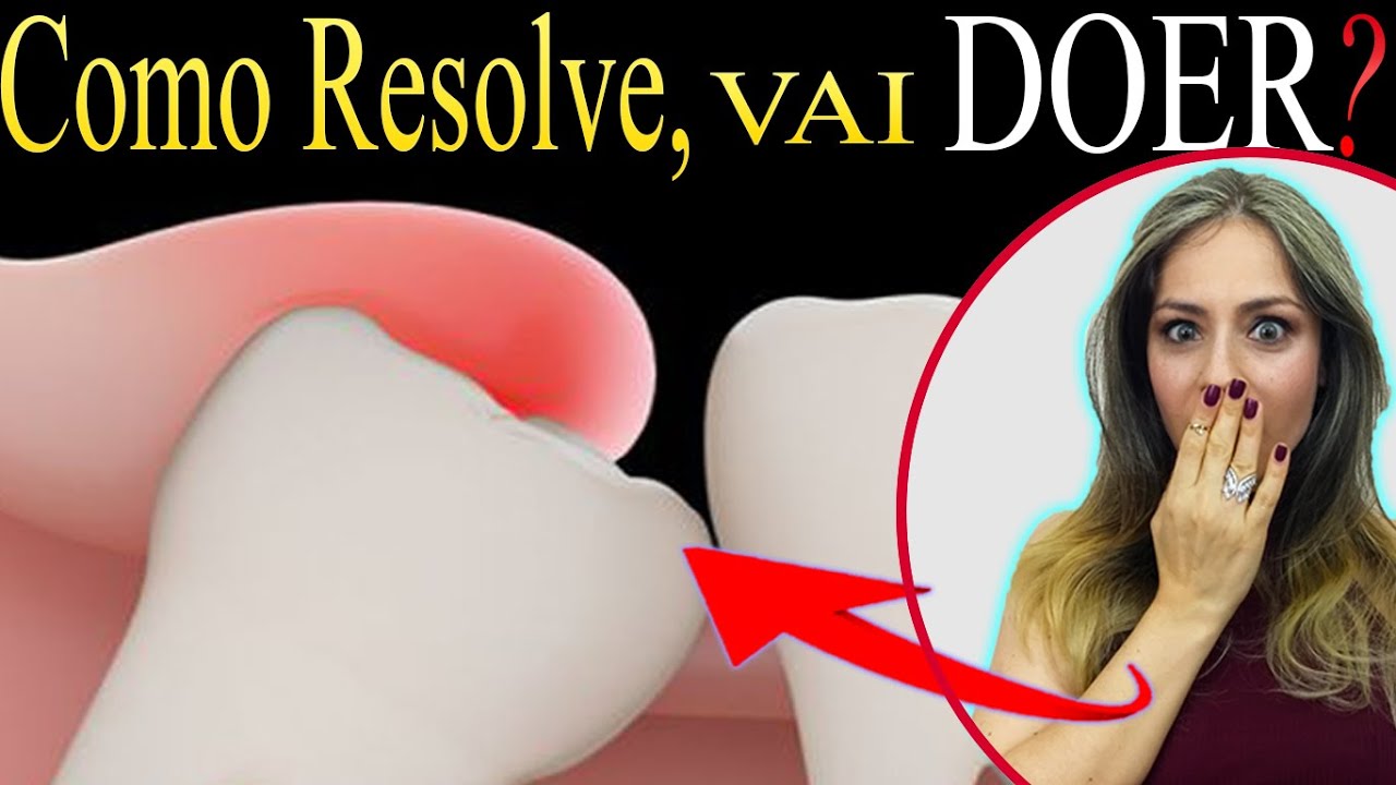 Pericoronarite o que é e qual o (Tratamento RÁPIDO). Gengiva sobre o Dente do Siso Inflamada