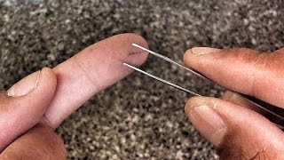 How to remove a splinter