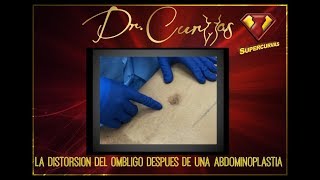 Distorsión de Ombligo Después de una Abdominoplastia | Dr.Cortes