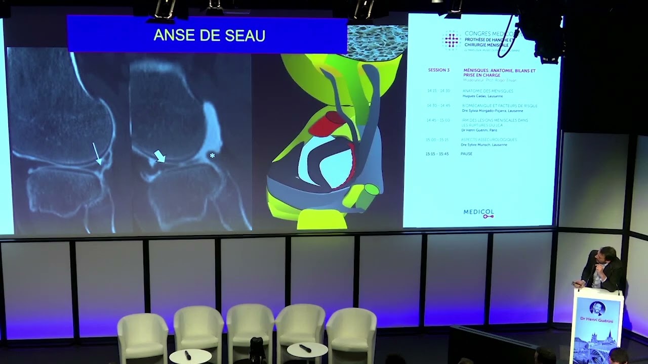 IRM des lésions méniscales dans les ruptures du LCA - Dr Henri Guérini