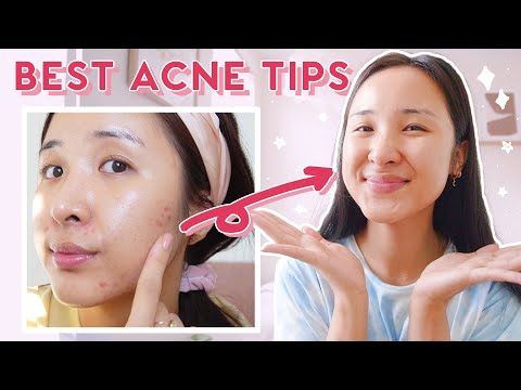 How to Use AHA, BHA & Niacinamide for ACNE & HYPERPIGMENTATION! (2021)