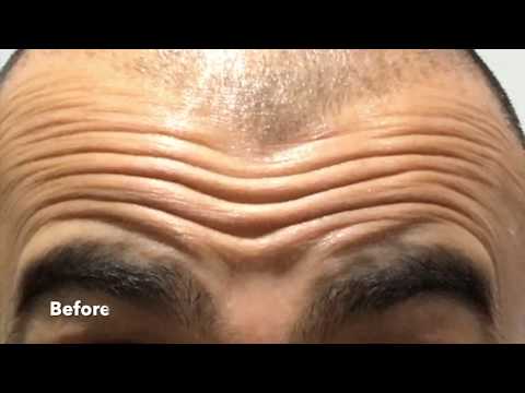 Brotox Forehead Lines Before and After - Men's Botox Results.
