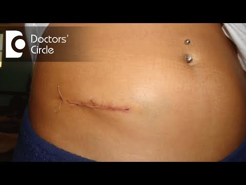 What is the recovery time from Laparoscopic Appendectomy? - Dr. Sathish N