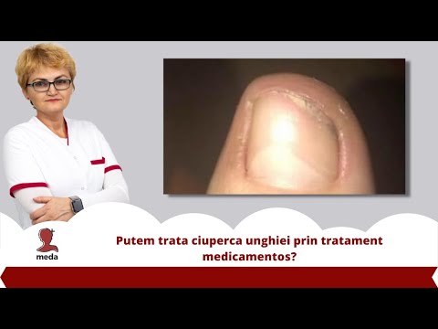 Tratamentul ciupercii unghiilor și palmelor