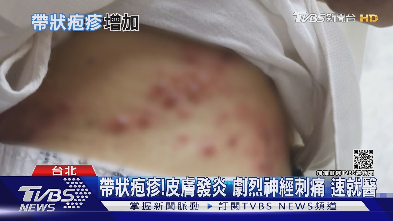 有片／輕忽身體警訊免疫力下降小心！皮蛇纏身　醫警告恐發生這件事
