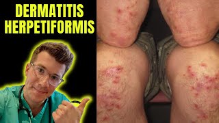 Dermatitis Herpetiformis (rash seen in Coeliac Disease aka gluten intolerance) explained...