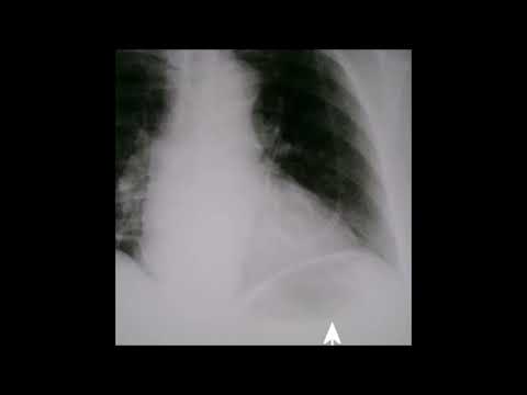 deadrazy - pasaisviesisз marts no kadaફ (2018)