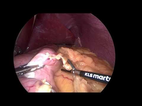 marSeal5 plus – Sleeve gastrectomy