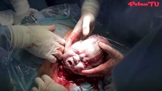 Cięcie cesarskie trojaczków - Triplets cesarean section | PolnaTV