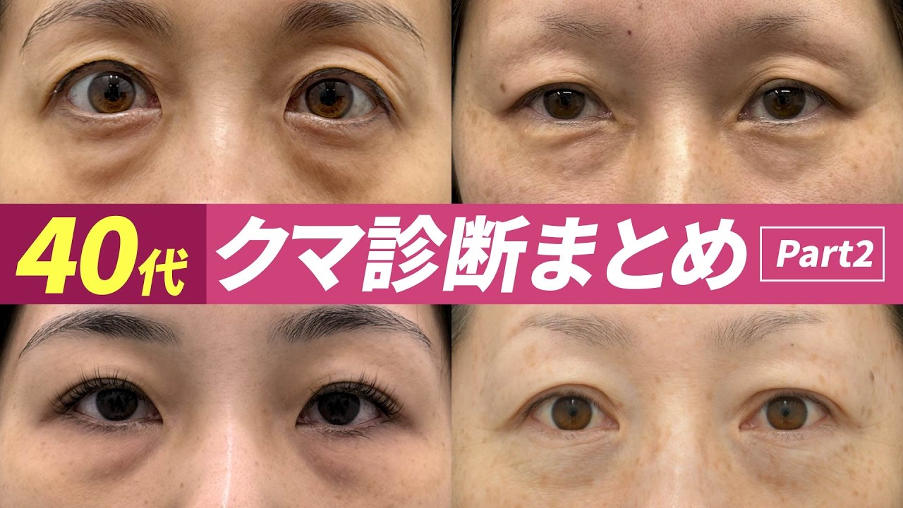 【保存版】40代からのクマ取り失敗しない選び方。湘南美容の最新症例から学ぶ、あなたに最適な施術とは？#クマ取り #クマ取整形 #目の下のクマ #クマ取りナビ #裏ハムラ #湘南美容クリニック