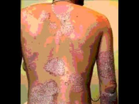 Cura di psoriasi di un tyansha Il neurodermatitis è trasmesso al bambino