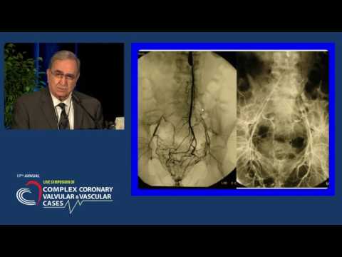 My Technique for Aortoiliac Reconstruction