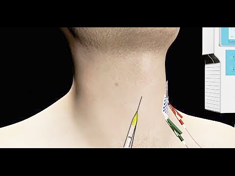 Spasmodic Dysphonia Treated with EMG Guided Botox Injection