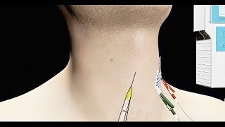Spasmodic Dysphonia Treated with EMG Guided Botox Injection