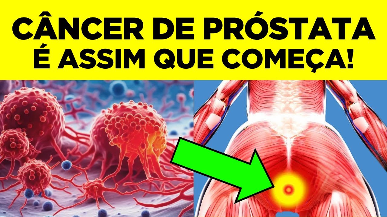 CÂNCER DE PRÓSTATA: Primeiros Sinais e Sintomas, NÃO IGNORE!