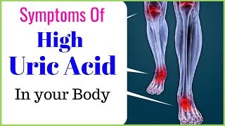 Signs and symptoms of high uric acid level in a body