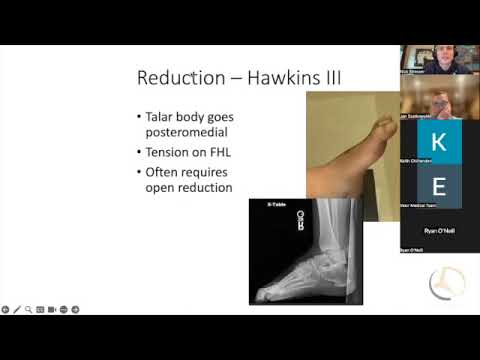 Talus Fractures AVN and surgical timing   SD 480p