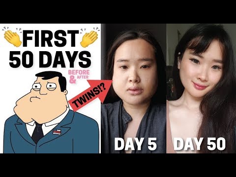 Double jaw surgery and Vline surgery FOODTALES