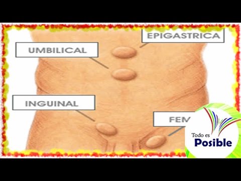 Los diferentes tipos de hernias