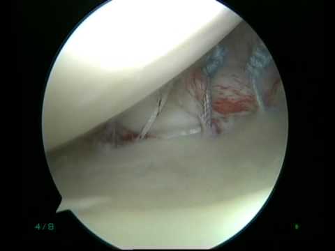 Pre- And Postoperative Perthes Deficiency Correction