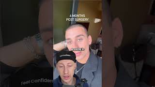 What Do You Think Of His Hair Transplant Result?