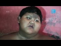 Arya Permana Kisah Bocah 10 Tahun Dengan Bobot Tubuh 190 Kg