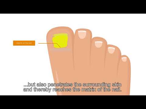 Fungalix Forte Patented Fungal Nail Treatment incl. subs