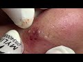 Very Rare Blackheads Flower Pattern Linh My Dang