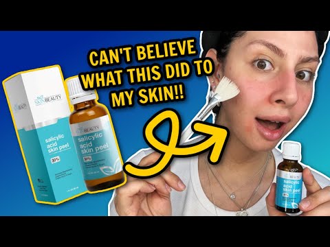 Trying out the ACID SKIN PEEL from Skin Beauty Solutions 😱