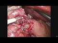 『胃癌』全腹腔鏡次全胃切除手術 laparoscopic subtotal gastrectomy with Billroth II reconstruction