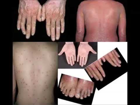 กลากเชื้อรา โรคผิวหนังภูมิแพ้ผิวหนังอักเสบ