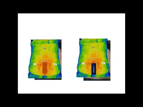 Effect of Transcutaneous Neuromodulation on Normalization of Dermal Body Temperature in Tender Scar