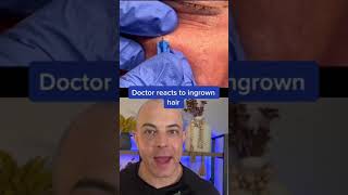 Doctor reacts to ingrown hair removal! #ingrownhair #dermreacts #doctorreacts